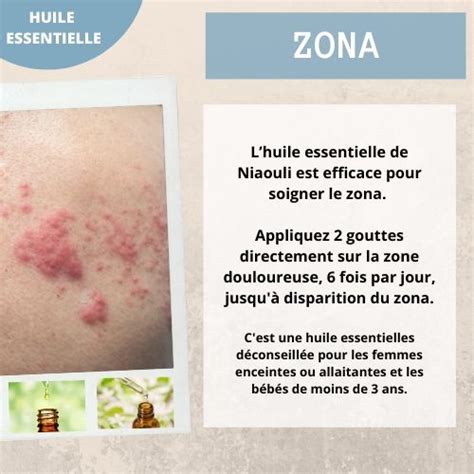 Traitement Zona Avec Les Huiles Essentielles Huiles Essentielles Et