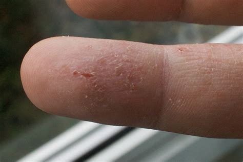 Eczema Versus Fingerprints 2009 A Follow Up To My 2005 Blo Flickr