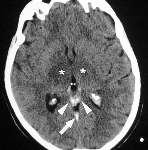 Cerebral Venous Thrombosis And Multidetector Ct Angiography Tips And