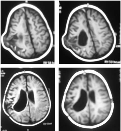 T1 Weighted Mri Brain Showing The Previous Patient After Repair Was