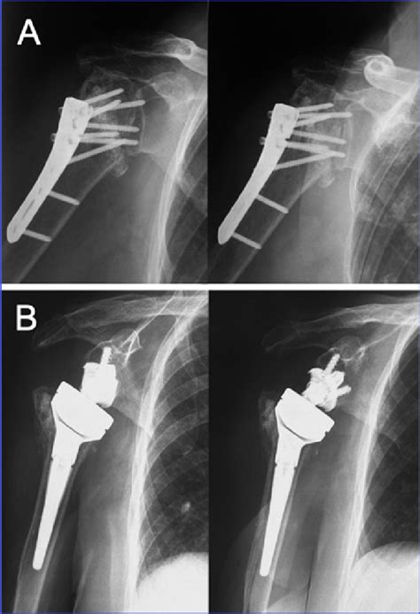 A Avascular Necrosis Following Open Reduction And Internal Fixation Of