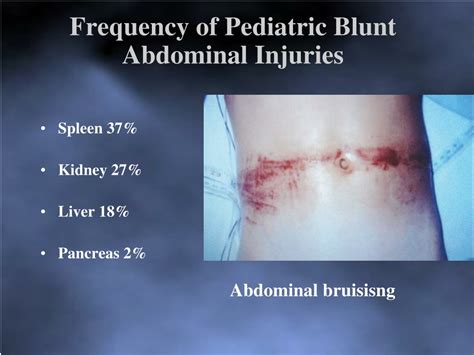Ppt Management Of Blunt And Penetrating Abdominal Trauma In Children