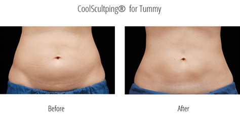 before_after_coolsculpting_stomach