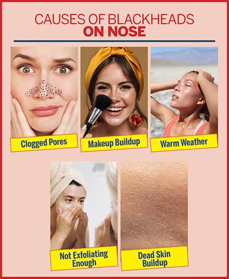Blackheads On Nose And How To Get Rid Of Them