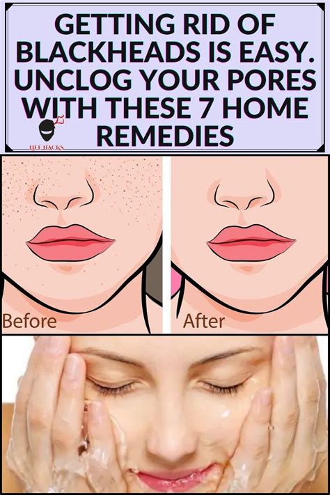 Getting Rid Of Blackheads Is Easy Unclog Your Pores With These 7 Home