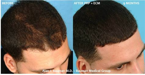 Half of fifty year olds are quite bald. 36 y/o Male PRP w/ECM Hair Regrowth Results · Bauman ...
