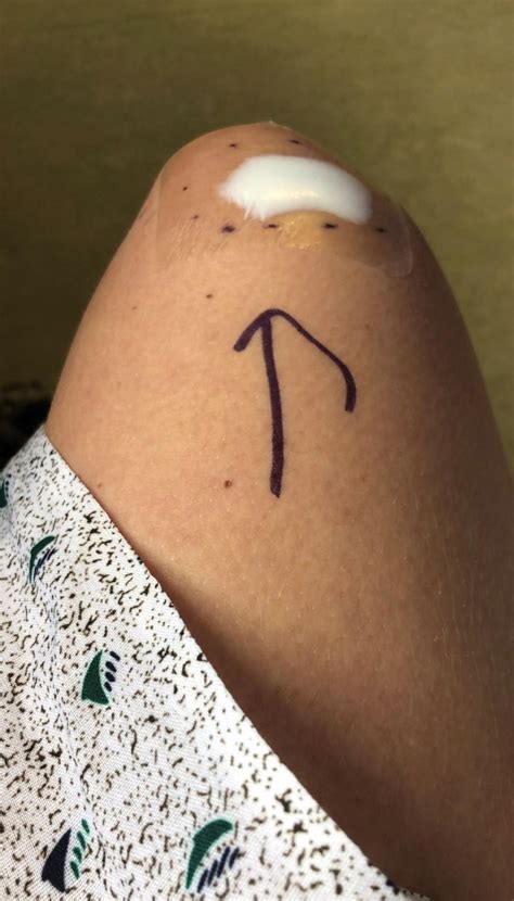 Mole Turned Into Stage 3 Melanoma In A Month