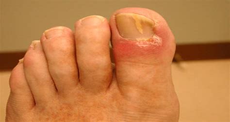 Apple cider vinegar is popular in folk medicine and used as an ancient remedy for treating a wide variety of conditions. Get Rid of Fungal Nail Infection by Using Baking Soda And ...