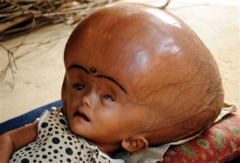 Tragic Indian Babys Head Swells Up To Huge Size Picture Ibtimes Uk