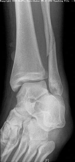 Ankle Fracture Wikem