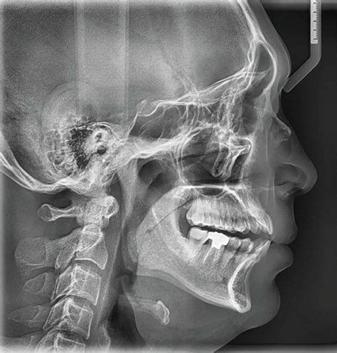 Medical Dentix ¿qué Es La Radiografía Cefalométrica