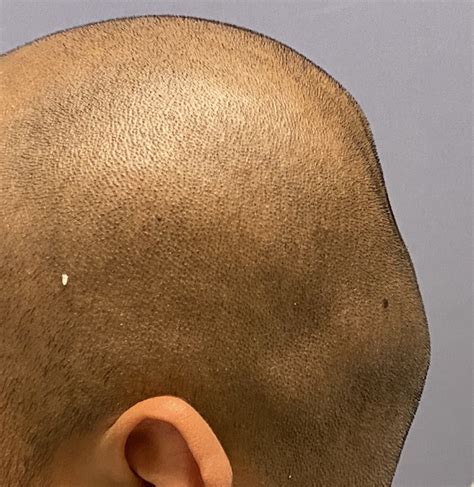 Plastic Surgery Case Study Skull Reshaping With Custom Skull Implant