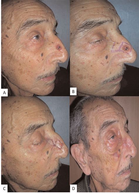 A Preoperative Appearance Of Basal Cell Carcinoma On The Nose B