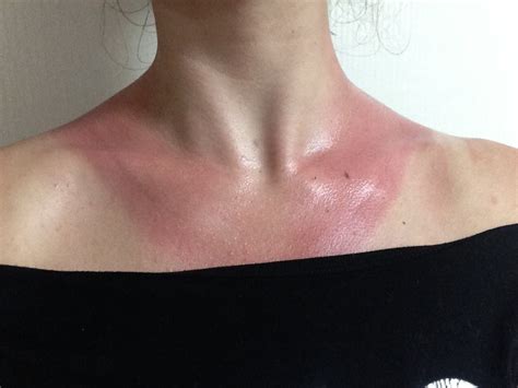 Sunburn Remedy Instant Pain Relief And Overnight Healing Living In