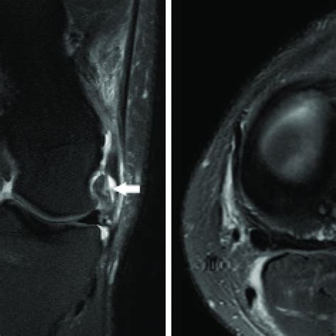 Pdf Magnetic Resonance Imaging Evaluation Of Common Peroneal Nerve