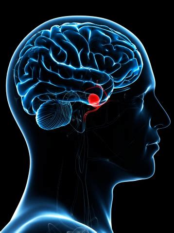 It can be linked with hardening of the arteries, also known ventricular aneurysm. Brain Aneurysm | Brain Institute | OHSU