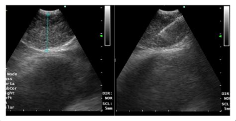 Endobronchial Ultrasound View Of The Right Paratracheal Lymph Node With