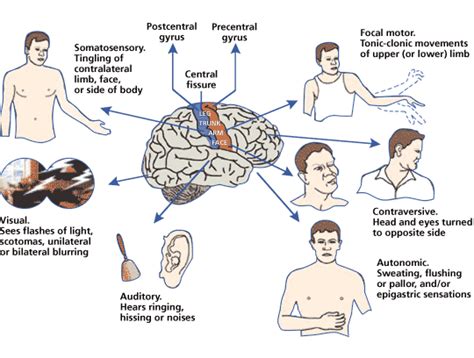partial seizures epilepsy causes symptoms treatment partial seizures epilepsy