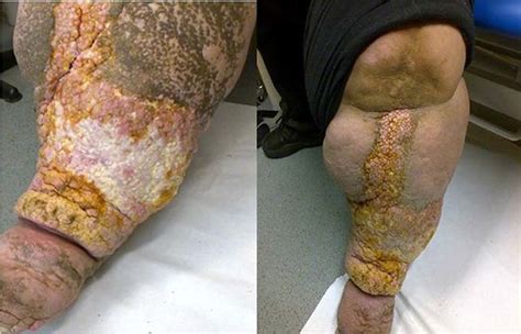 It should also suit the condition of the periwound skin. UCS™ Debridement