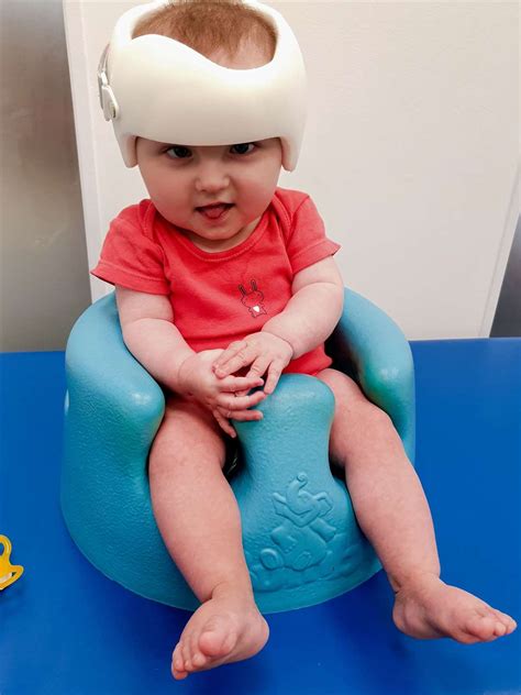 Special Helmet For Gillingham Tot Born With Flat Head Syndrome