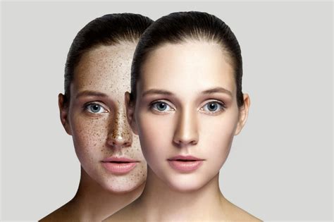 Hyperpigmentation Seeing Beyond Concealers For Luminous Skin