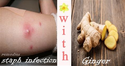 17 Home Remedies For Staph Infection On Face Leg And Others Parts