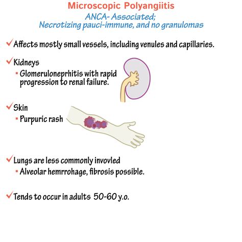 Pathology Glossary Microscopic Polyangiitis Draw It To Know It