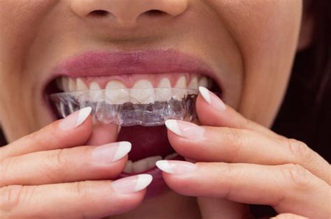 Traditional Braces Vs Invisalign Reopelle Orthodontics