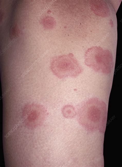 Erythema Multiforme Target Lesions Stock Image C0531912 Science