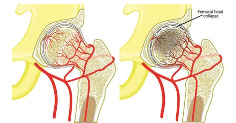 Avascular Necrosis Symptoms Causes Diagnosis Treatment Prevention