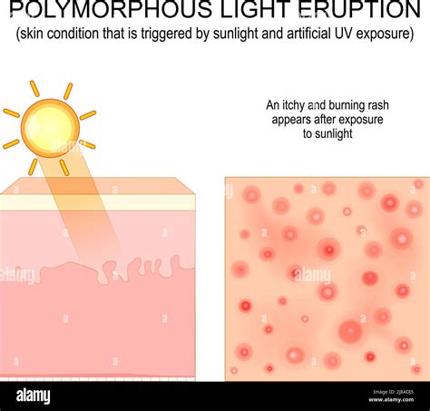 Polymorphic Light Eruption An Itchy And Burning Rash Appears After