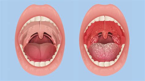 How Do You Know If You Have Tonsillitis Everyday Health