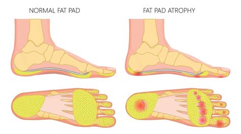 James Mccormack On Twitter Do You Include Calcaneal Fat Pad Atrophy