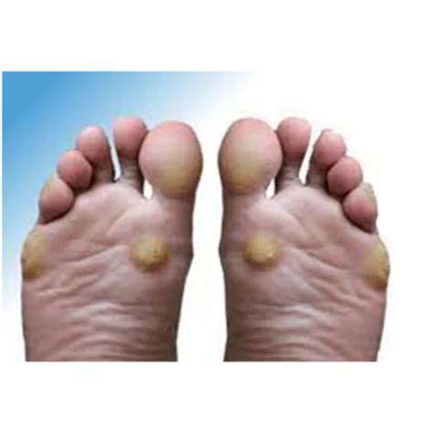 Foot Corn Treatment In Homeopathy Packaging Size Small Box Id