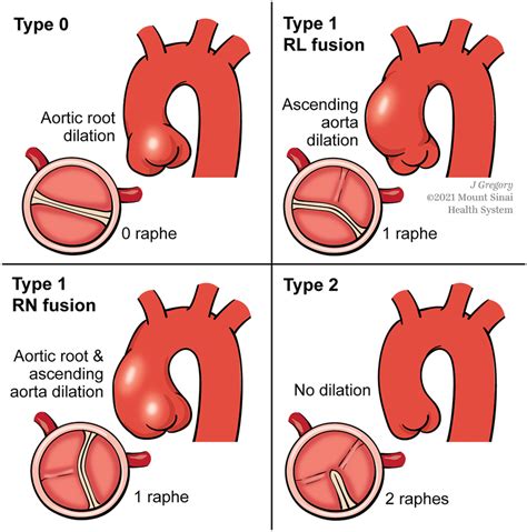 Aortic Root And Ascending Aorta Dilation With Bicuspid Aortic Valve Download Scientific