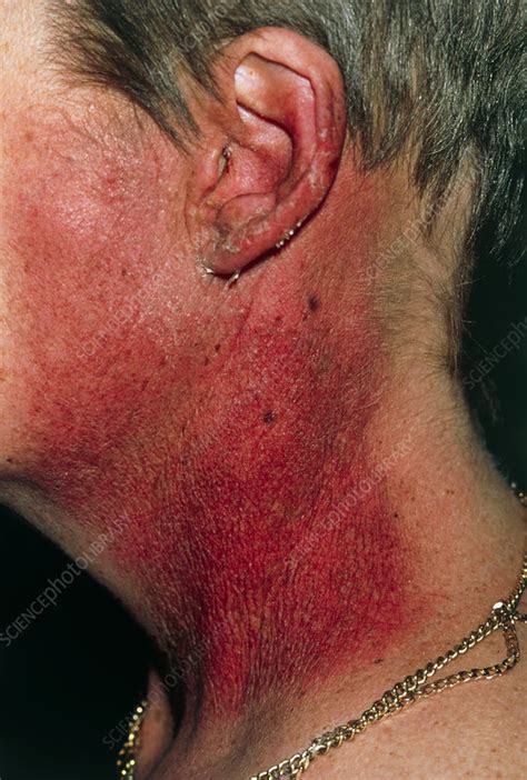 Neck With Parotid Cancer Red From Radiotherapy Stock Image M131