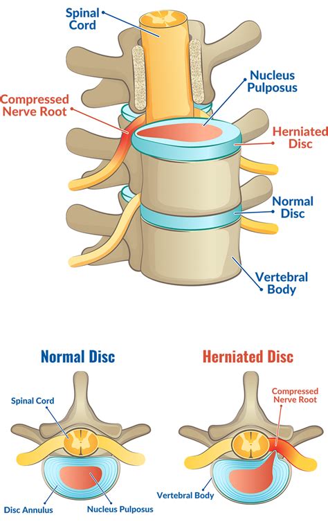 Unexpected Symptoms Of A Herniated Disc Core Orthopedics