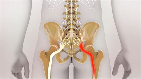 The Different Types Of Sciatic Nerve Pain Delaware Valley Pain Spine InstituteChalfont Pain