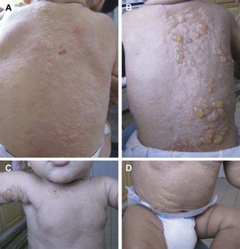 Generalized Bullous Eruption After Routine Vaccination In A Child With
