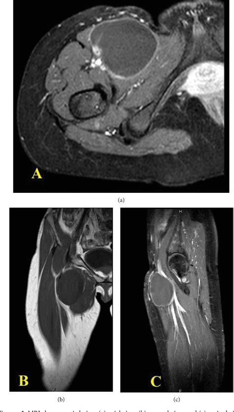 Figure 2 From An Unusual Presentation Of Idiopathic Lymphatic Cyst Of