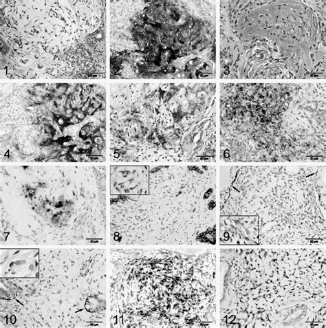 Immunostainings Of Myxoid Tissues In Complex And Mixed Tumors The