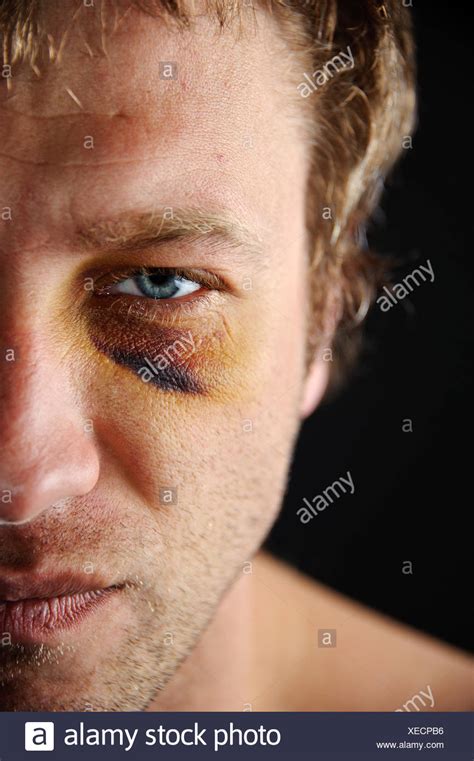 Bruised Face Man Stock Photos And Bruised Face Man Stock Images Alamy