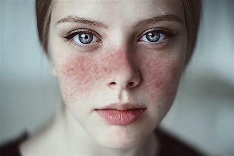 20 Signs And Symptoms That You May Have Lupus Lifedaily