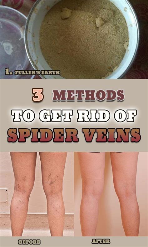 3 Natural Ways To Get Rid Of Spider Veins Get Rid Of Spider Veins Spider Veins Get Rid Of