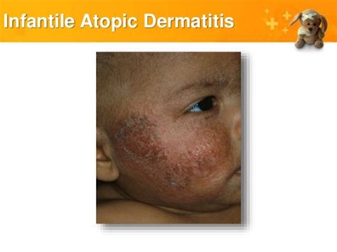 Common Pediatric Skin Rash