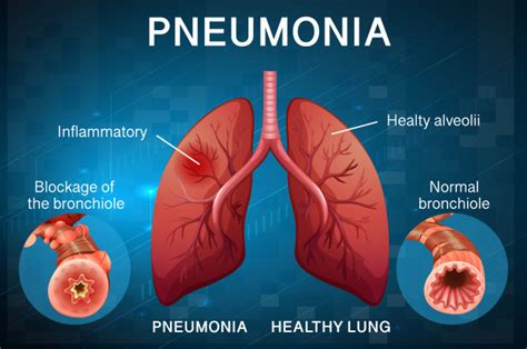 Poster Design For Pneumonia With Human Lungs Free Vector