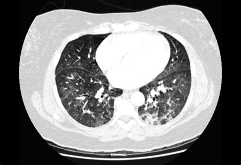 Pulmonary Edema Ct Wikidoc