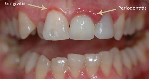 Check spelling or type a new query. Gum Disease Natural Treatments & Home Remedies