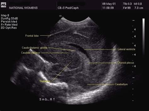 Neonatal Head Ultrasound New Health Advisor