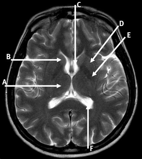 Magnetic Resonance Imaging Of The Axial Structures Of The Brain The Bmj